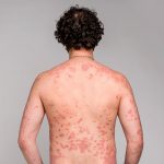 Псориаз